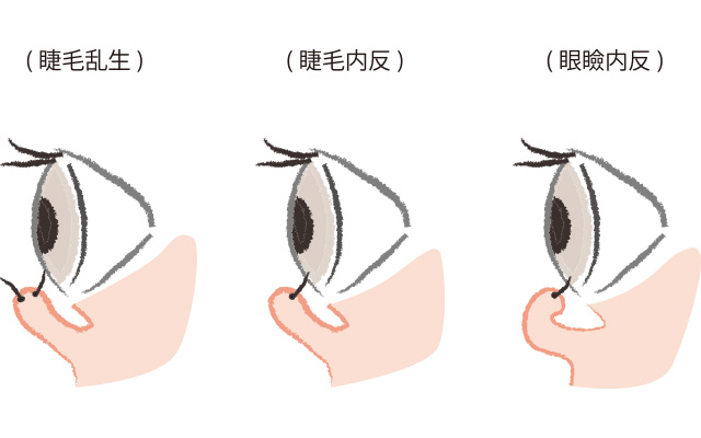 逆さまつ毛の種類