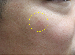 3 month After 1st treatment