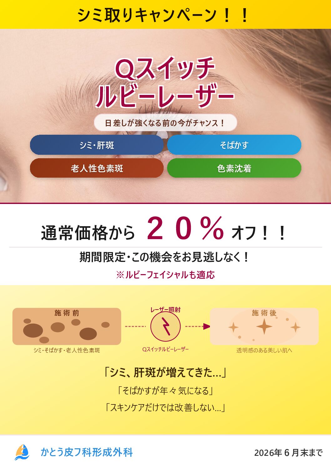 6月シミ取りキャンペーン